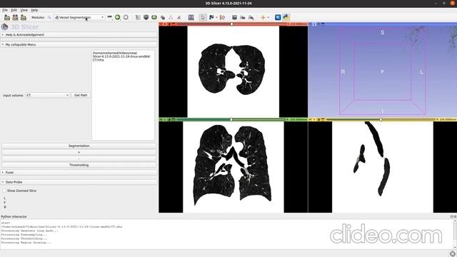 Blood Vessel Segmentation (3D Slicer) смотреть онлайн