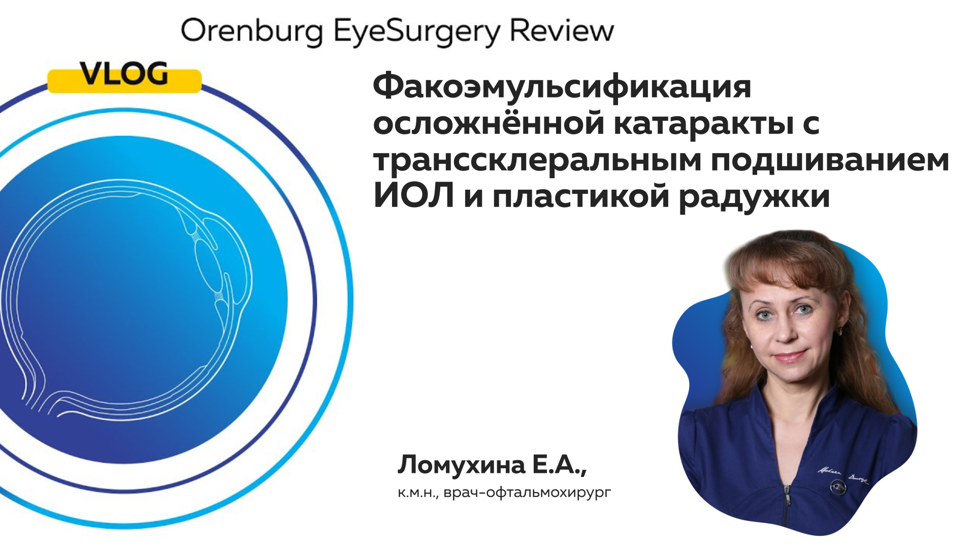Факоэмульсификация осложнённой катаракты с транссклеральным подшиванием ИОЛ и пластикой радужки
