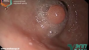 ЭНДОСКОПИЧЕСКОЕ УДАЛЕНИЕ ПОЛИПОВ ЖЕЛУДКА