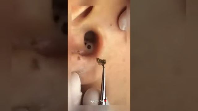 Черная точка из уха #угри #чёрнаядыра #уха