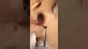 Черная точка из уха #угри #чёрнаядыра #уха