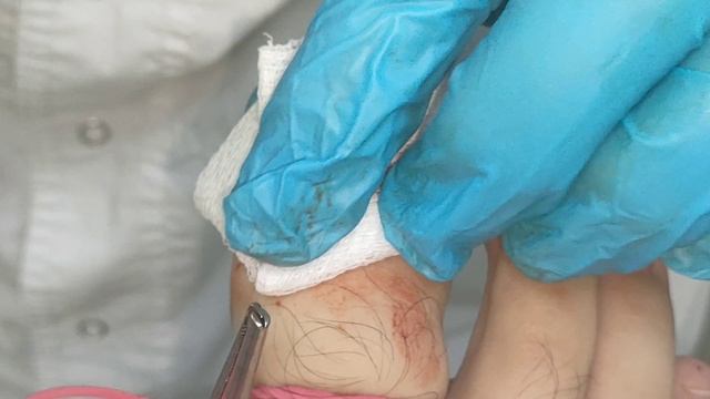 Лечение вросшего ногтя (ОНИХОКРИПТОЗА) РАДИОВОЛНОВЫМ методом смотреть онлайн