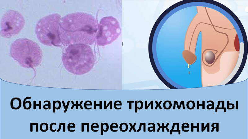 Обнаружение трихомонады после переохлаждения смотреть онлайн