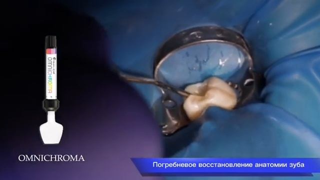 Реставрация дефекта по 1 классу зуба 3.6 — Клиника PROTECOMED смотреть онлайн