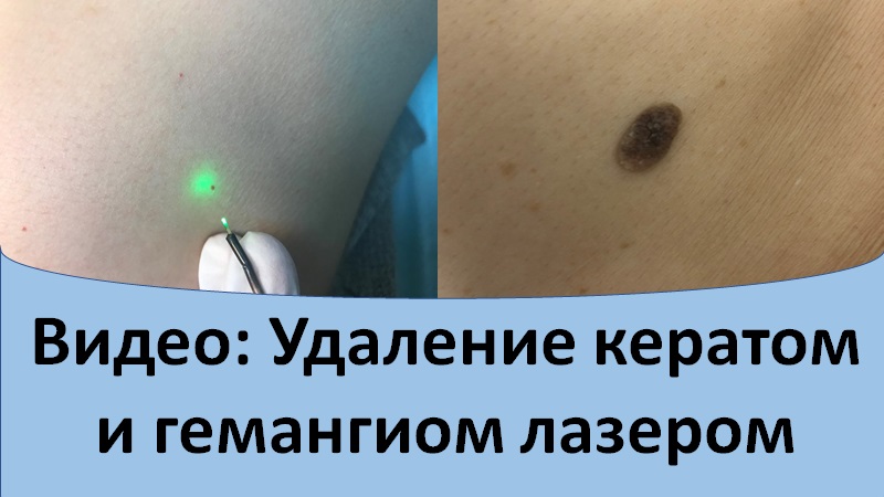 Удаление кератом и гемангиом лазером. смотреть онлайн