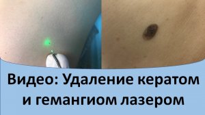 Удаление кератом и гемангиом лазером.