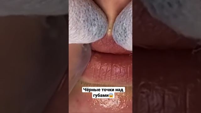 Чёрные точки над губами смотреть онлайн
