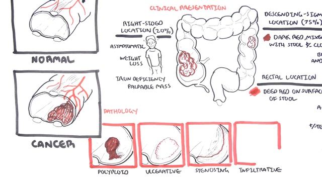 Colorectal Cancer - Overview смотреть онлайн