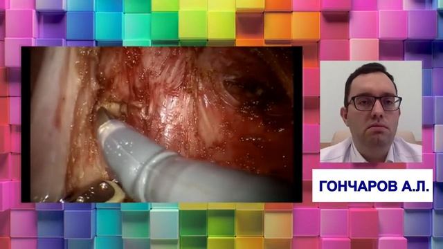 Эндофест2020. Лапароскопическая и роботическая колоректальная хирургия. смотреть онлайн