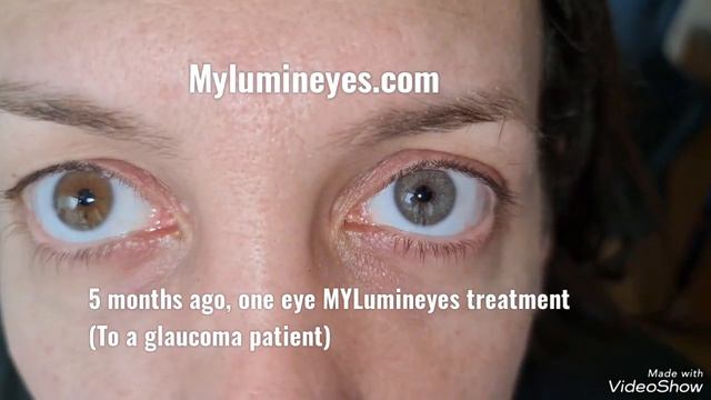 Laser Eye Color Change Surgery (Lumineyes) On A Glaucoma Patient! @eyecolorchange