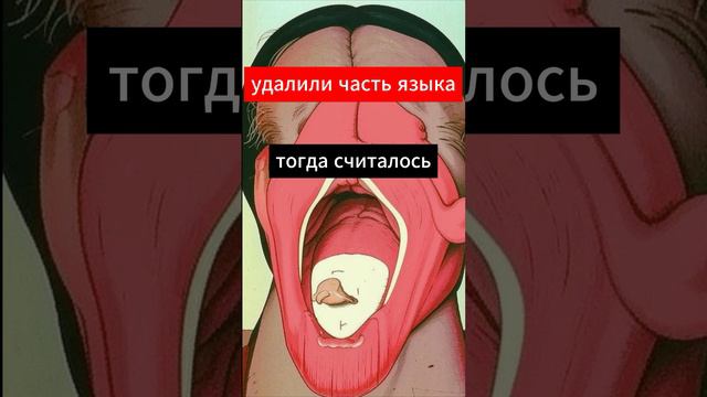 Заикание лечили так! смотреть онлайн