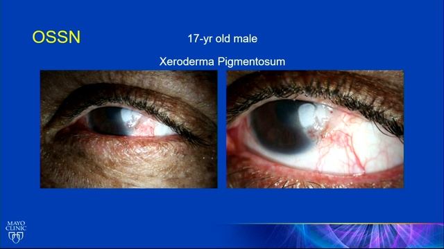 AIOC2020 - IC75 - Recent Advances In The Diagnosis And Management Of Tumors Of The Ocular Surface смотреть онлайн