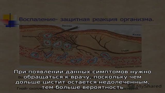 Код цистита в МКБ 10 смотреть онлайн