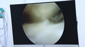 артроскопическая резекция менискы