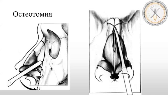 Заседание секции Пластическая хирургия: Ринопластика смотреть онлайн