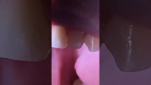 Enameloplasty after Braces - Dental Cosmetic procedure - Tooth Time Family Dentistry New Braunfels смотреть онлайн