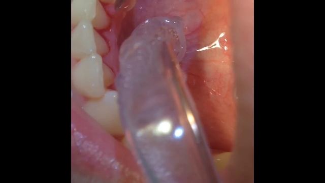 Удаление над и под десневых зубных отложений. Скайлинг смотреть онлайн