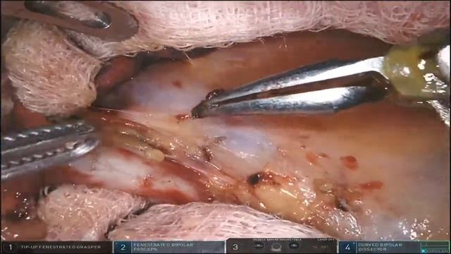 Robotic Thoracic Lymph Node Dissection Xi (Unedited RUL) смотреть онлайн
