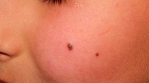 Что делать если содрал родинку