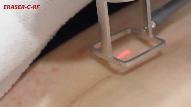 Eraser-C-RF - многофункциональная CO2 лазерная система (процедура коррекции рубца) смотреть онлайн