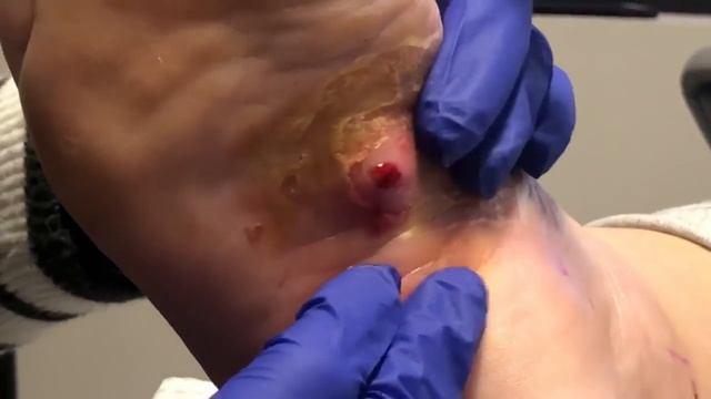 INSANE INCLUSION CYST