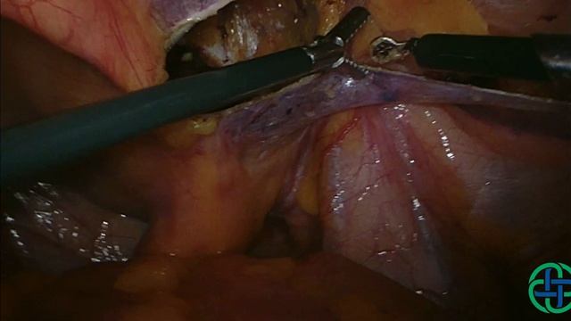 Лапароскопия паховой грыжи