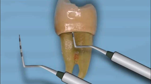 Вторичный кариес