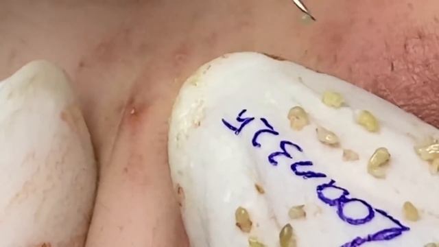 Addictive when watching blackheads pop up (325) | Loan Nguyen смотреть онлайн