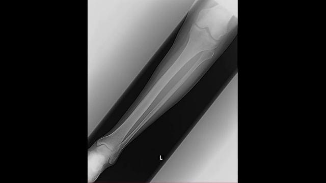 Укладка голени