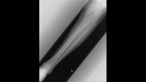 Укладка голени