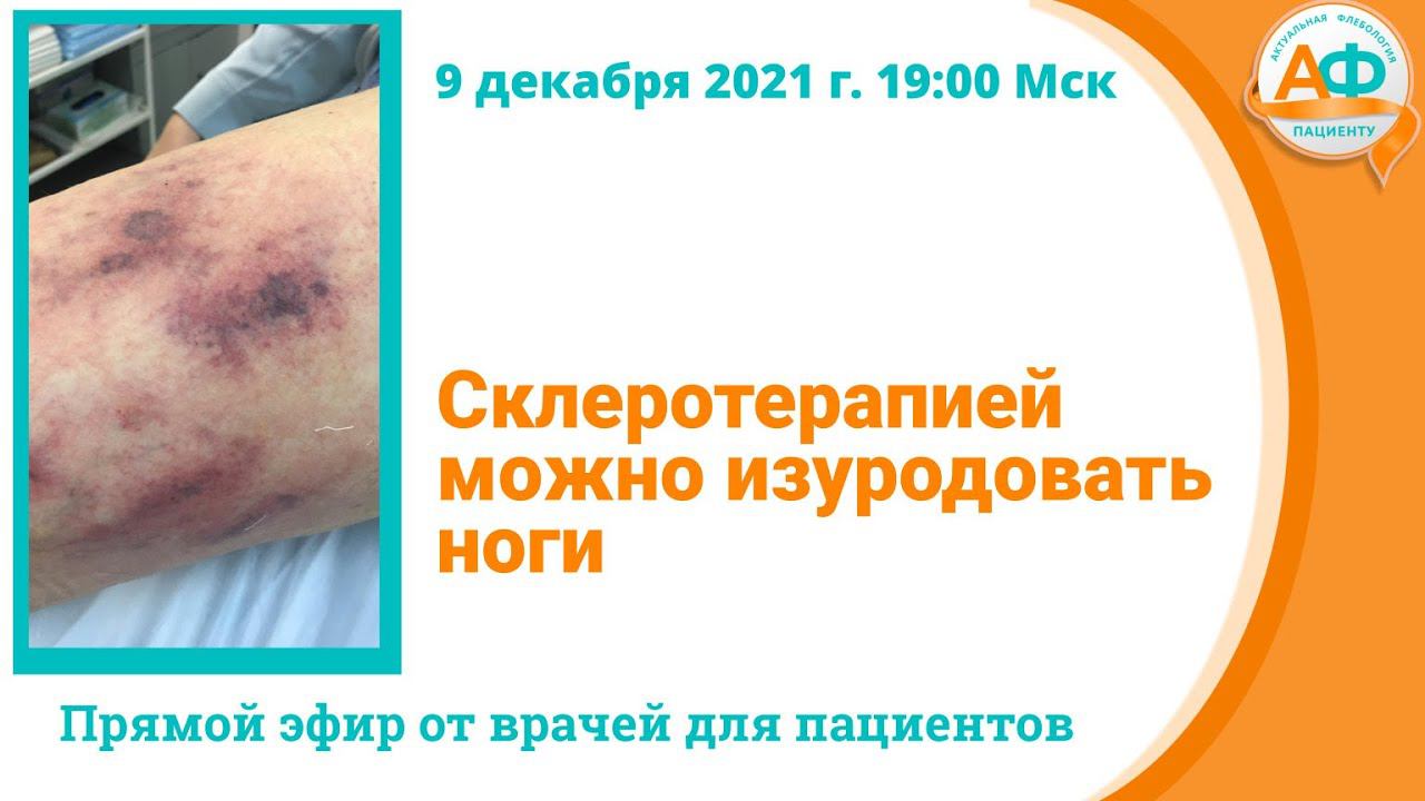 Склеротерапией можно изуродовать ноги смотреть онлайн