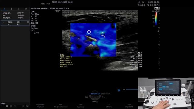 Измерение жесткости ткани печени с помощью технологии S-Shearwave смотреть онлайн