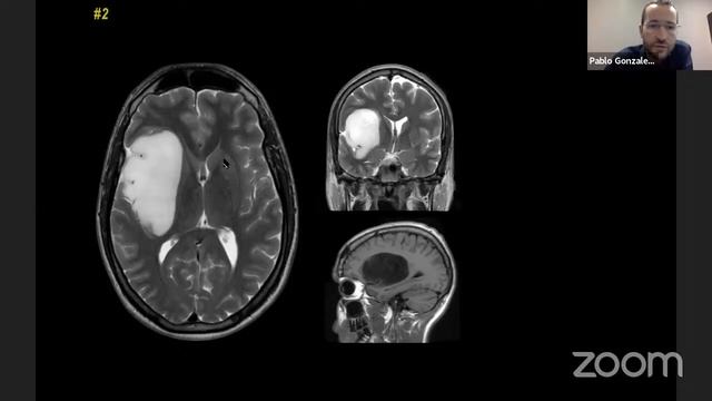 Rhoton Neuroanatomy Module IV - Exploring the Brain Session I смотреть онлайн