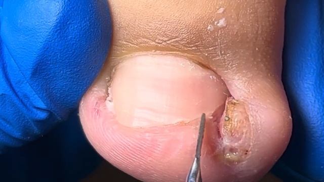 Pedicure Tutorial: Ingrown Nails Quick Fix!【Xue Yidao Pedicure】