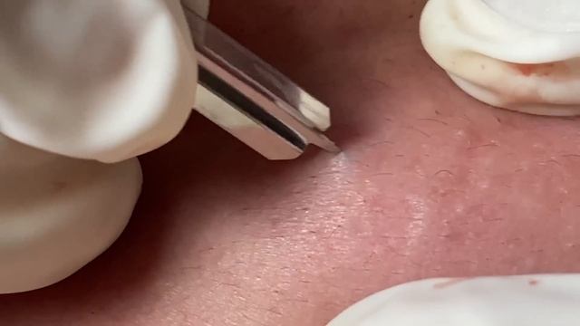 Make your Acne Treatment Huong Da Nang | 453# acne 2022 смотреть онлайн