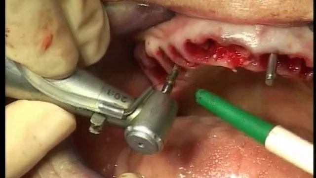 Dental implant and bimaxillary immediate loading - Part 2 смотреть онлайн