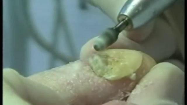 Nagelprothetik mit UNGUISAN - Teil 1: Vorbereitende Maßnahmen смотреть онлайн