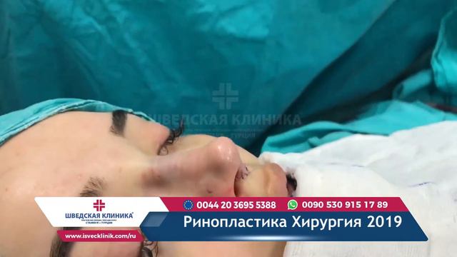 Ринопластика Хирургия 2019 смотреть онлайн