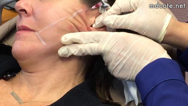 Jowl and Neck Lifting with Nova Threads смотреть онлайн