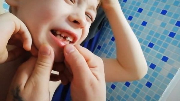 Как выдернуть молочный зуб.
