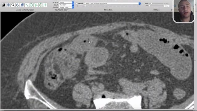 GIT | Bowel obstruction | Gall stone Ileus смотреть онлайн
