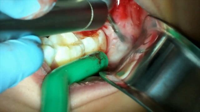 WISDOM teeth extraction surgery - Surgical extraction tutorial W/ steps and tips. смотреть онлайн
