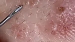 ✅ Выдавливание прыщей #22