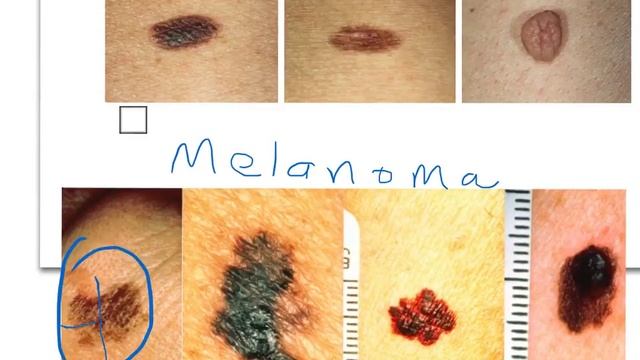 Nevi vs Melanoma смотреть онлайн