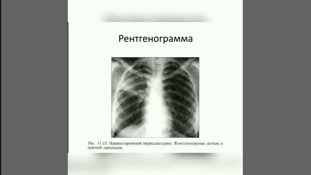 Очаговый туберкулез Инфильтративный туберкулез Казеозная пневмония Туберкулема легких смотреть онлайн
