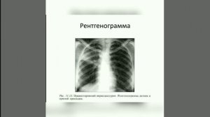 Очаговый туберкулез  Инфильтративный туберкулез  Казеозная пневмония  Туберкулема легких