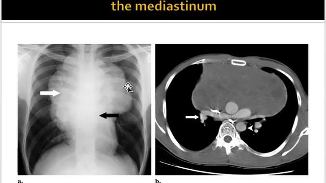 Mediastinal masses approach смотреть онлайн