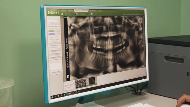 3d снимки, компьютерная томография зубов в стоматологической клинике "Совершенная улыбка" смотреть онлайн