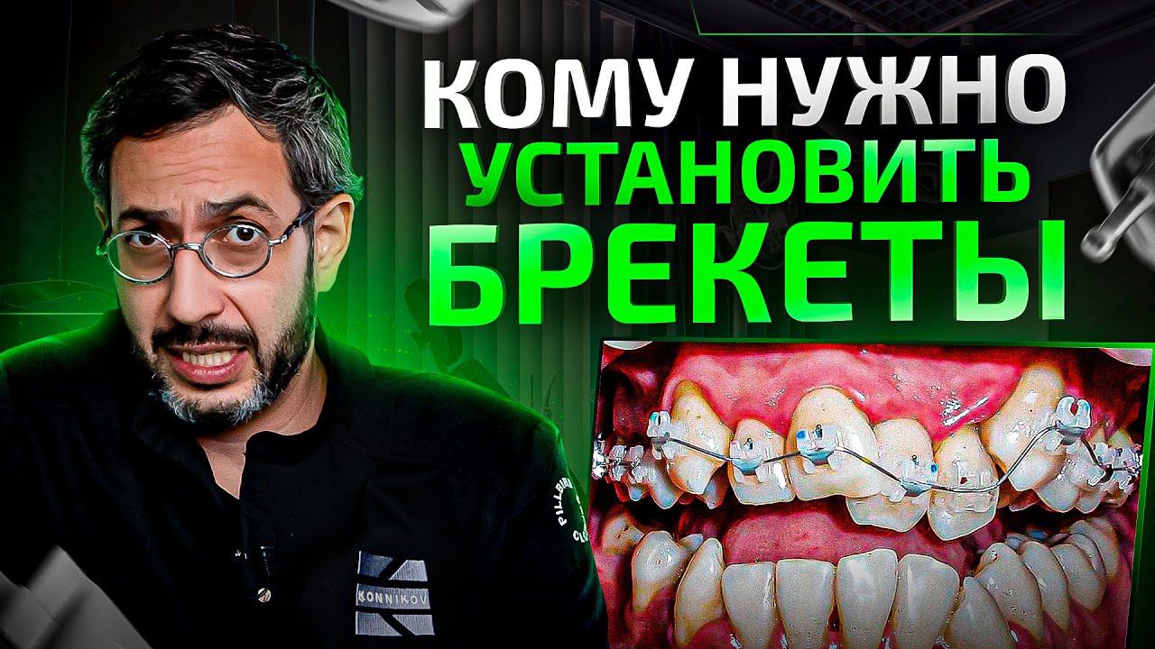 Установка брекетов в клинике Олега Конникова. Как это происходит?
