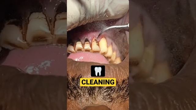Pan - Smokers Teeth Cleaning #teethcleaning #dirtyteeth смотреть онлайн